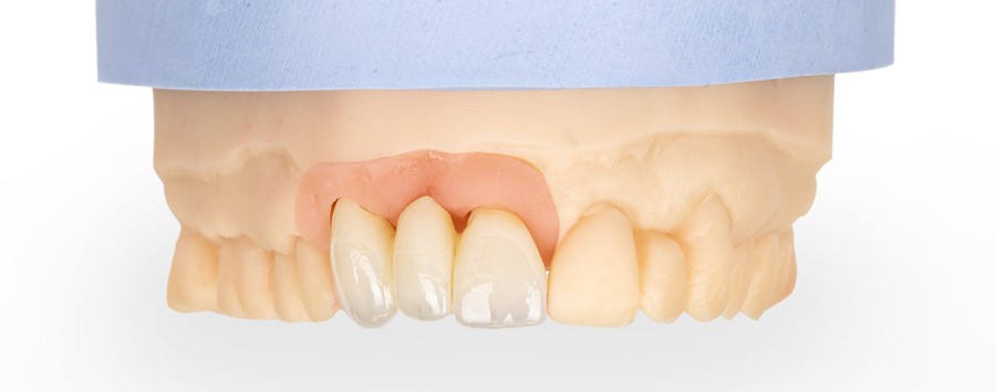 Sprays LiSi Cerafusion Low Glaze para acabamento em zircônia